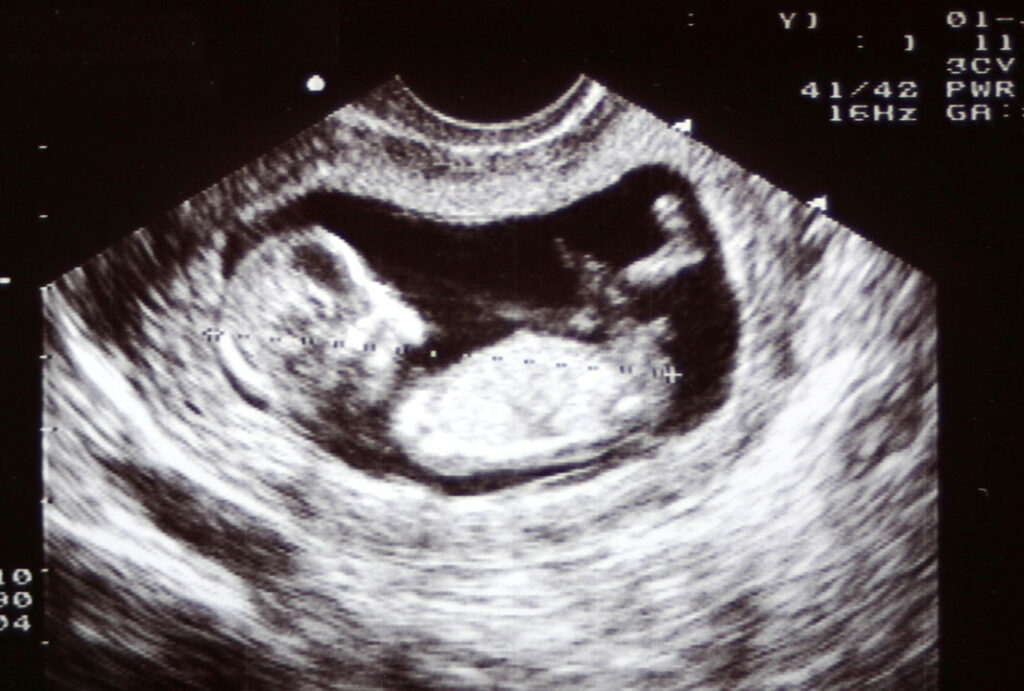 Baby scan - 12 week black and white scan showing the formation of the baby resting on its back with knees bent