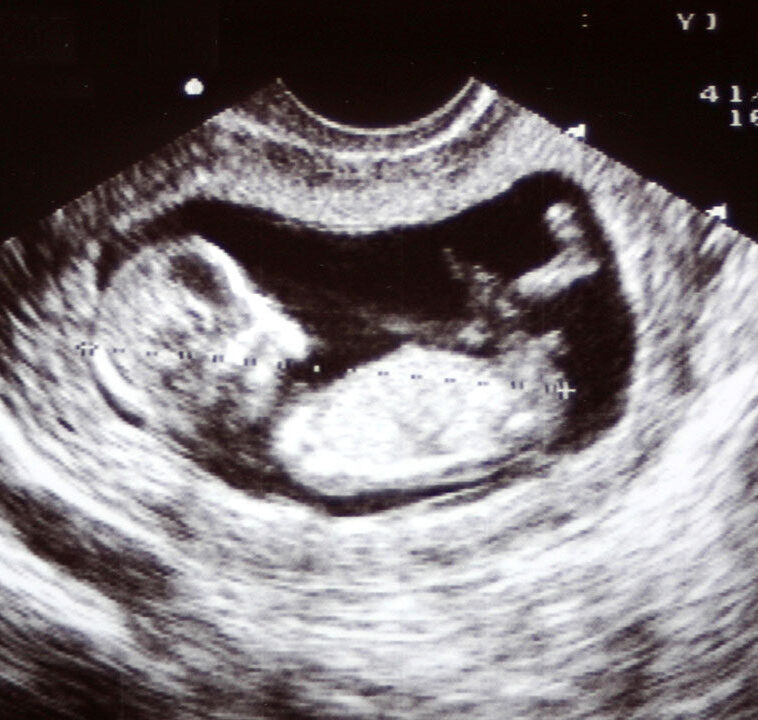 Baby scan - 12 week black and white scan showing the formation of the baby resting on its back with knees bent